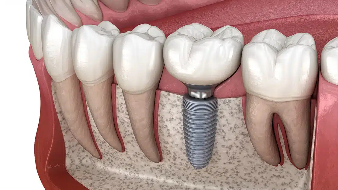 Dental Implant Restoration